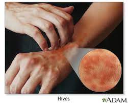 Hives Urticaria Symptoms And Causes