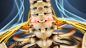 Cervical Facet Osteoarthritis Video