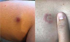 Ticks are active from april through october, meaning they're here to potentially ruin all of your outdoor activities. Council To Put Up Warnings About Ticks After Woman Reports Catching Lyme Disease In Clissold Park Hackney Citizen