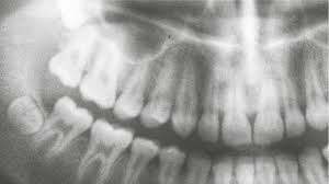 Rupture unilatérale de pacs : Blog Dentaire Centre Ville De Montreal Dentiste Oracare