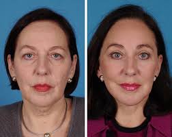 The Prevalence of Blepharoptosis in Facial Rejuvenation Patient Population 