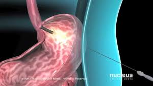 Percutaneous Endoscopic Gastrostomy Peg Feeding Tube Youtube