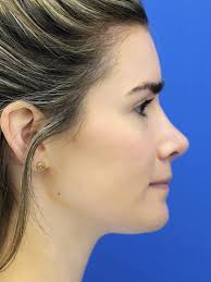 Cases in Rhinoplasty Revision