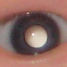 Eye cancer is a general term used to describe the types of cancer that can develop on or within the eye. Smartphone App Can Help Detect Leukocoria A Sign Of Eye Cancer Shots Health News Npr