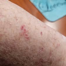 Image result for liver spots on legs