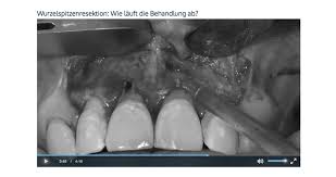 Entzündungen des inneren weichgewebeanteils des zahnes (der sog. Wurzelspitzenresektion Rettung Fur Kranke Zahne