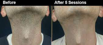 Know laser hair removal, without laser methods, home remedies and involved risks. Neck Laser Hair Removal For In Atlanta Wifh