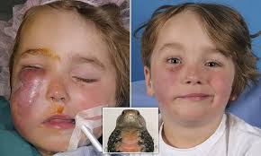 Search, discover and share your favorite g flip meme gifs. Dutch Boy 4 Suffers Facial Paralysis After Cobra Bit Him While Asleep On South African Safari Daily Mail Online