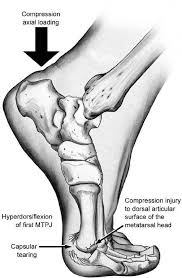 Turf toe refers to an injury that affects the ligaments around a person's big toe. Turf Toe Wars