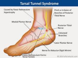 Tarsal Tunnel Syndrome Boca Raton Boynton Beach Foot Doctors
