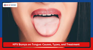 Image result for papillomavirus tongue)