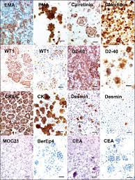 It is concluded that strong diffuse linear staining for ema is a good marker of malignancy when differentiating epithelioid malignant mesothelioma and . Guidelines For Cytopathologic Diagnosis Of Epithelioid And Mixed Type Malignant Mesothelioma Complementary Statement From The International Mesothelioma Interest Group Also Endorsed By The International Academy Of Cytology And The Papanicolaou Society Of
