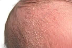 Image result for Cradle Cap