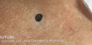 Dr Pimple Popper Huge Whitehead Gushes Out Egg Salad Looking Liquid Pimples Zits Popping Doctor Pimple Popper