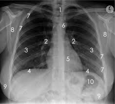 We did not find results for: Chest X Ray Anatomy Flashcards Quizlet