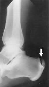 Cosm Chronic Achilles Tendon Problems