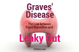 Hyperthyroidism in graves' disease is confirmed, as with any other cause of hyperthyroidism, by measuring elevated blood levels of free (unbound) t3 and t4. Graves Disease The Link Between Thyroid And Leaky Gut Doctor Doni