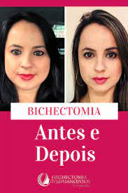 Os dias que antecedem a operação devem contar com medidas extremas de higiene bucal. Foto Antes E Depois Da Bichectomia Em 2020 Fotos Antes E Depois Cirurgia Plastica Kit De Cuidado