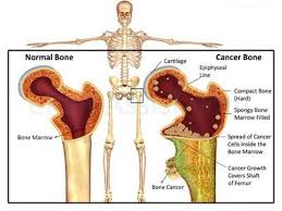 Pin On Cancer