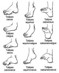 It involves a foot that is often swollen, has a plantarflexed first metatarsal and an extended big toe. 32 Clubfoot Ideas Club Foot Club Foot Baby Pediatric Physical Therapy