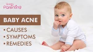 See full list on wikihow.com Baby Acne Causes Symptoms Treatment Youtube