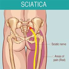 The iliopsoas muscle, which extends from the lower back to. Sciatica Nerve Pain Treatment In Alappuzha Numbness And Weakness In Leg