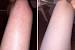 Before And After Lactic Acid Lotion