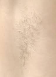 See reviews, photos, directions, phone numbers and more for the best hair removal in tacoma, wa. Laser Hair Removal Seattle Dr Javad Sajan