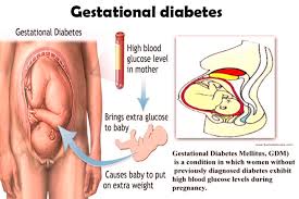 gestational diabetes diabetes conference 2020