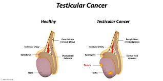 A lump or swelling can be one of the first symptoms of testicular cancer. Testicular Cancer Symptoms Private Gp Warwickshire Dr Jeff Foster