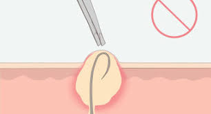 The hair is located on and around the sex organs and sometimes at the top of the inside of the thighs. How To Deal With Pubic Hair 10 Steps With Pictures Wikihow