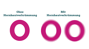 So sieht der betroffene patient in die nähe oder in der ferne verzerrt und unscharf. Kann Ich Bei Einer Hornhautverkrummung Kontaktlinsen Tragen Lensvision Kontaktlinsen