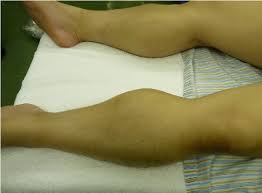 Image result for Compartment Syndrome