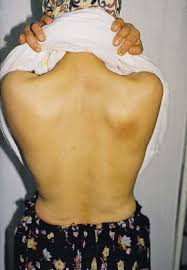 Image result for Notalgia Paresthetica