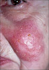 Spider bites are actually rare. Is This Painful Swelling A Spider Bite
