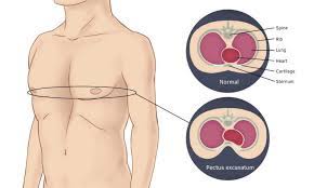 Pectus excavatum is a congenital deformity of the chest wall that causes several ribs and the breastbone (sternum) to grow in an inward direction. What Causes Chest Wall Deformity Or Pectus Excavatum