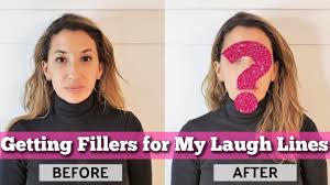 He estimates the average cost at $2,900 to $4,900. Getting Fillers For My Laugh Lines Nasolabial Folds With Dr Andrea Herschorn Before After Youtube