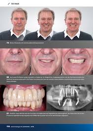 Implant Case article