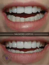 How long does a porcelain veneer last? Composite Veneers Unbiased Professional Review For 2020