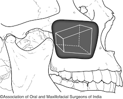Image result for Maxillary Sinus