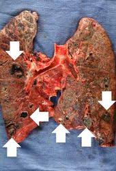 Image result for Lung Abscess