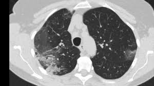 Ct scans are most often done you may also be asked to hold your breath for a short time, since chest movement can affect the image. The Radiology Assistant Covid 19 Imaging Findings