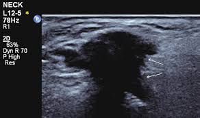 • thyroid and neck ultrasound (including central and lateral compartments), if not previously done. Head And Neck Ultrasound Technical Advances Novel Applications And The Role Of Elastography Clinical Radiology