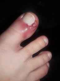 Apply antibiotic or antifungal lotion directly to the nail and to the skin under and around the nail. My Infected Ingrown Toenail Mildlydisgusting