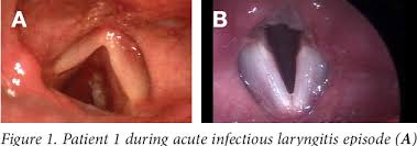 Image result for Acute Laryngitis