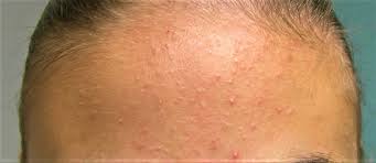 Maybe you would like to learn more about one of these? Whiteheads Causes Find Out How To Get Rid Of Whiteheads