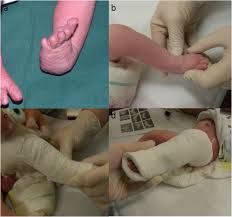 The vast majority of clubfoot deformities are congenital in nature, and therefore acquired during development in the uterus and not through heredity. Clubfoot Treatment With Ponseti Method Parental Distress During Plaster Casting Journal Of Orthopaedic Surgery And Research Full Text