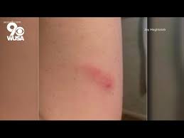 Image result for mite bites on humans