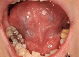 Image result for Erythroplakia roof of mouth