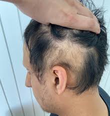 Image result for Alopecia